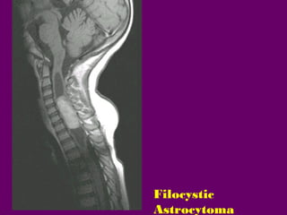 Filocystic
Astrocytoma

 