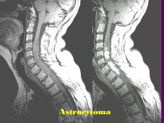 Astrocytoma

 