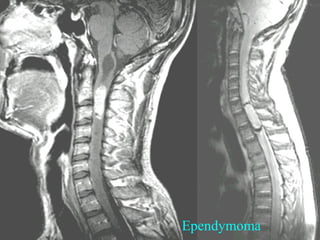 Ependymoma

 