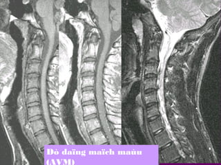 Dò daïng maïch maùu
(AVM)

 