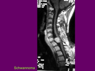 Schwannoma

 