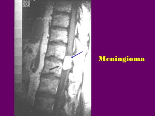 Meningioma

 