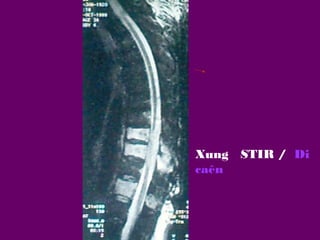Xung STIR / Di
caên

 