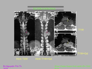 SCHWANNOMA

T1W

T1W+Gd
Hình T2W
Bn.Nguyeãn Thò Th.

Hình T1W+Gd
Khoa Chaån ñoaùn hình aûnh /Bv Chôï

 