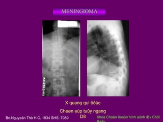 MENINGIOMA

X quang qui öôùc
Cheøn eùp tuûy ngang
D8
Khoa Chaån ñoaùn hình aûnh /Bv Chôï
Bn.Nguyeãn Thò H.C. 1934 SHS: 7089

 