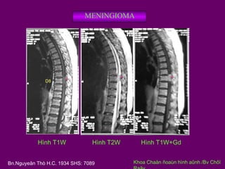 MENINGIOMA

D8

Hình T1W

Hình T2W

Bn.Nguyeãn Thò H.C. 1934 SHS: 7089

Hình T1W+Gd
Khoa Chaån ñoaùn hình aûnh /Bv Chôï

 