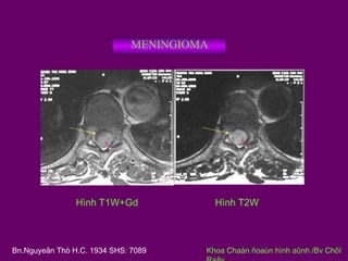 MENINGIOMA

Hình T1W+Gd

Bn.Nguyeãn Thò H.C. 1934 SHS: 7089

Hình T2W

Khoa Chaån ñoaùn hình aûnh /Bv Chôï

 