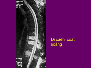 Di caên coät
soáng

 