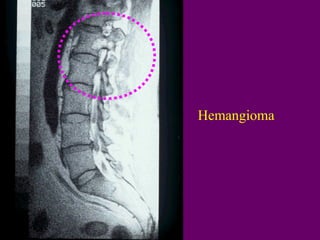 Hemangioma

 