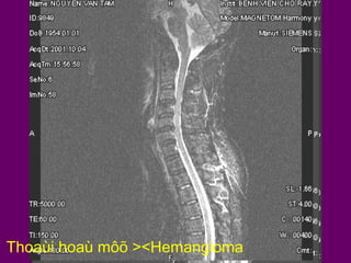 Thoaùi hoaù môõ ><Hemangioma

 
