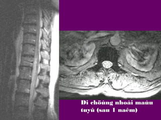 Di chöùng nhoài maùu
tuyû (sau 1 naêm)

 