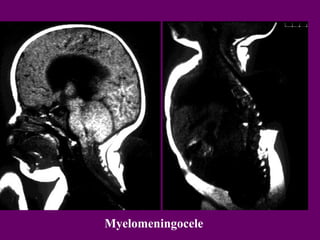 Myelomeningocele

 
