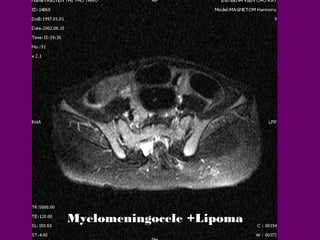 Myelomeningocele +Lipoma

 