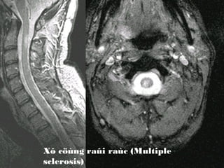 Xô cöùng raûi raùc (Multiple
sclerosis)

 