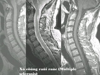 MS

Xô cöùng raûi raùc (Multiple
sclerosis)

 