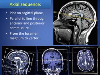 Axial sequence:
• Plot on sagittal plane,
• Parallel to line through
anterior and posterior
commissure ,
• From the foramen
magnum to vertex .
9/3/2013 15MRI Brain by Sudil
 
