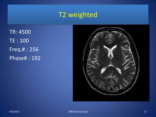 T2 weighted
TR: 4500
TE : 100
Freq.# : 256
Phase# : 192
9/3/2013 17MRI Brain by Sudil
 