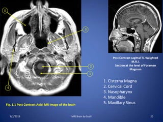 Fig. 1.1 Post Contrast Axial MR Image of the brain
1
2
3
4
5
Post Contrast sagittal T1 Weighted
M.R.I.
Section at the level of Foramen
Magnum
1. Cisterna Magna
2. Cervical Cord
3. Nasopharynx
4. Mandible
5. Maxillary Sinus
9/3/2013 20MRI Brain by Sudil
 
