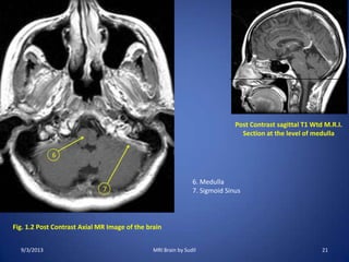 Fig. 1.2 Post Contrast Axial MR Image of the brain
7
6
Post Contrast sagittal T1 Wtd M.R.I.
Section at the level of medulla
6. Medulla
7. Sigmoid Sinus
9/3/2013 21MRI Brain by Sudil
 