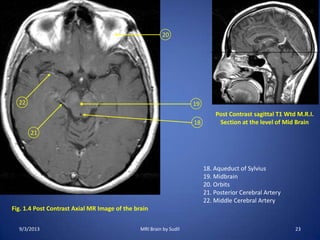 Fig. 1.4 Post Contrast Axial MR Image of the brain
18
19
20
21
22
Post Contrast sagittal T1 Wtd M.R.I.
Section at the level of Mid Brain
18. Aqueduct of Sylvius
19. Midbrain
20. Orbits
21. Posterior Cerebral Artery
22. Middle Cerebral Artery
9/3/2013 23MRI Brain by Sudil
 