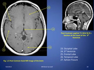 Fig. 1.5 Post Contrast Axial MR Image of the brain
23
24
25
26
27
Post Contrast sagittal T1 Wtd M.R.I.
Section at the level of the 3rd
Ventricle
23. Occipital Lobe
24. 3rd Ventricle
25. Frontal Lobe
26. Temporal Lobe
27. Sylvian Fissure
9/3/2013 24MRI Brain by Sudil
 