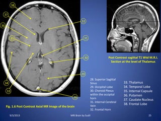 Fig. 1.6 Post Contrast Axial MR Image of the brain
28
29
30
31
32
38
33
34
36
35
37
Post Contrast sagittal T1 Wtd M.R.I.
Section at the level of Thalamus
28. Superior Sagittal
Sinus
29. Occipital Lobe
30. Choroid Plexus
within the occipital
horn
31. Internal Cerebral
Vein
32. Frontal Horn
33. Thalamus
34. Temporal Lobe
35. Internal Capsule
36. Putamen
37. Caudate Nucleus
38. Frontal Lobe
9/3/2013 25MRI Brain by Sudil
 