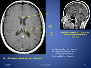 Fig. 1.7 Post Contrast Axial MR Image of the brain
39
40
41
Post Contrast sagittal T1 Wtd M.R.I.
Section at the level of Corpus
Callosum
39. Splenium of corpus callosum
40. Choroid plexus within the
body of lateral ventricle
41. Genu of corpus callosum
9/3/2013 26MRI Brain by Sudil
 