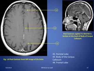 Fig. 1.8 Post Contrast Axial MR Image of the brain
42
43
44
Post Contrast sagittal T1 Wtd M.R.I.
Section at the level of Body of Corpus
Callosum
42. Parietal Lobe
43. Body of the Corpus
Callosum
44. Frontal Lobe
9/3/2013 27MRI Brain by Sudil
 