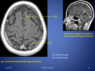 Fig. 1.9 Post Contrast Axial MR Image of the brain
45
46
Post Contrast sagittal T1 Wtd M.R.I.
Section above the Corpus Callosum
45. Parietal Lobe
46. Frontal Lobe
9/3/2013 28MRI Brain by Sudil
 