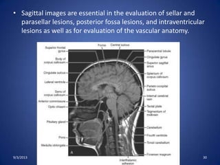 • Sagittal images are essential in the evaluation of sellar and
parasellar lesions, posterior fossa lesions, and intraventricular
lesions as well as for evaluation of the vascular anatomy.
9/3/2013 MRI Brain by Sudil 30
 