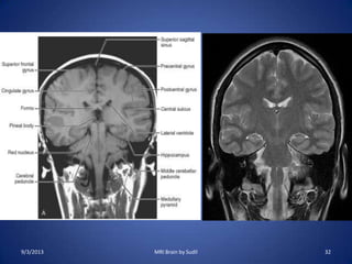 9/3/2013 MRI Brain by Sudil 32
 