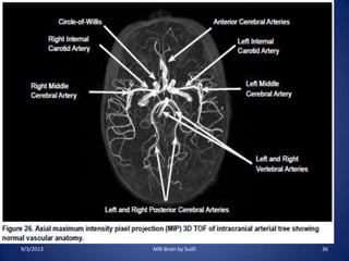 9/3/2013 MRI Brain by Sudil 36
 