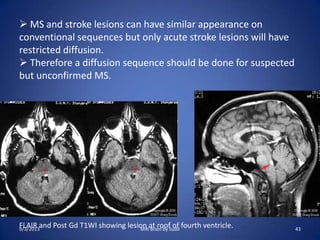 FLAIR and Post Gd T1WI showing lesion at roof of fourth ventricle.
 MS and stroke lesions can have similar appearance on
conventional sequences but only acute stroke lesions will have
restricted diffusion.
 Therefore a diffusion sequence should be done for suspected
but unconfirmed MS.
9/3/2013 43MRI Brain by Sudil
 