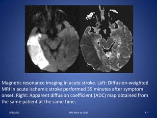Magnetic resonance imaging in acute stroke. Left: Diffusion-weighted
MRI in acute ischemic stroke performed 35 minutes after symptom
onset. Right: Apparent diffusion coefficient (ADC) map obtained from
the same patient at the same time.
9/3/2013 47MRI Brain by Sudil
 