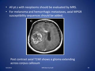 • All pt.s with neoplasms should be evaluated by MRS.
• For melanoma and hemorrhagic metastases, axial MPGR
susceptibility sequences should be added.
9/3/2013 MRI Brain by Sudil 49
Post contrast axial T1WI shows a glioma extending
across corpus callosum
 