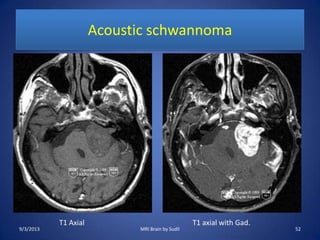 Acoustic schwannoma
T1 Axial T1 axial with Gad.
9/3/2013 52MRI Brain by Sudil
 