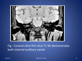 9/3/2013 MRI Brain by Sudil 54
Fig : Coronal ultra thin slice T1 WI demonstrates
both internal auditory canals
 