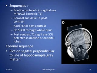 • Sequences :-
– Routine protocol ( in sagittal use
MPRAGE isotropic T1)
– Coronal and Axial T1 post
contrast
– Axial FLAIR post contrast
– 3D SPGR through whole brain
– Post contrast T1 sag if any SOL
detected in midline or occipital
lobes.
Coronal sequence
• Plot on sagittal perpendicular
to line of hippocamaple grey
matter.
9/3/2013 56MRI Brain by Sudil
 