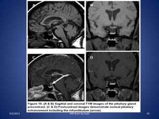 9/3/2013 59MRI Brain by Sudil
 