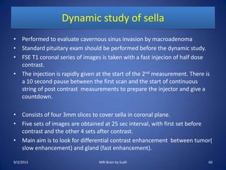 Dynamic study of sella
• Performed to evaluate cavernous sinus invasion by macroadenoma
• Standard pituitary exam should be performed before the dynamic study.
• FSE T1 coronal series of images is taken with a fast injecion of half dose
contrast.
• The injection is rapidly given at the start of the 2nd measurement. There is
a 10 second pause between the first scan and the start of continuous
string of post contrast measurements to prepare the injector and give a
countdown.
• Consists of four 3mm slices to cover sella in coronal plane.
• Five sets of images are obtained at 25 sec interval, with first set before
contrast and the other 4 sets after contrast.
• Main aim is to look for differential contrast enhancement between tumor(
slow enhancement) and gland (fast enhancement).
9/3/2013 MRI Brain by Sudil 60
 