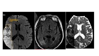 MRI PROCEDURE OF BRAIN | PPTX