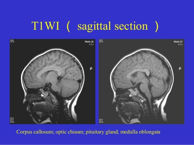 what is mri pituitary protocol
