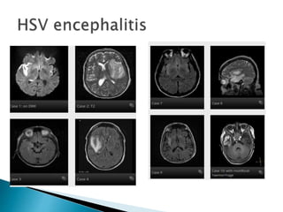 Mri brain imaging | PPTX