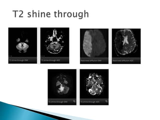 Mri brain imaging | PPTX
