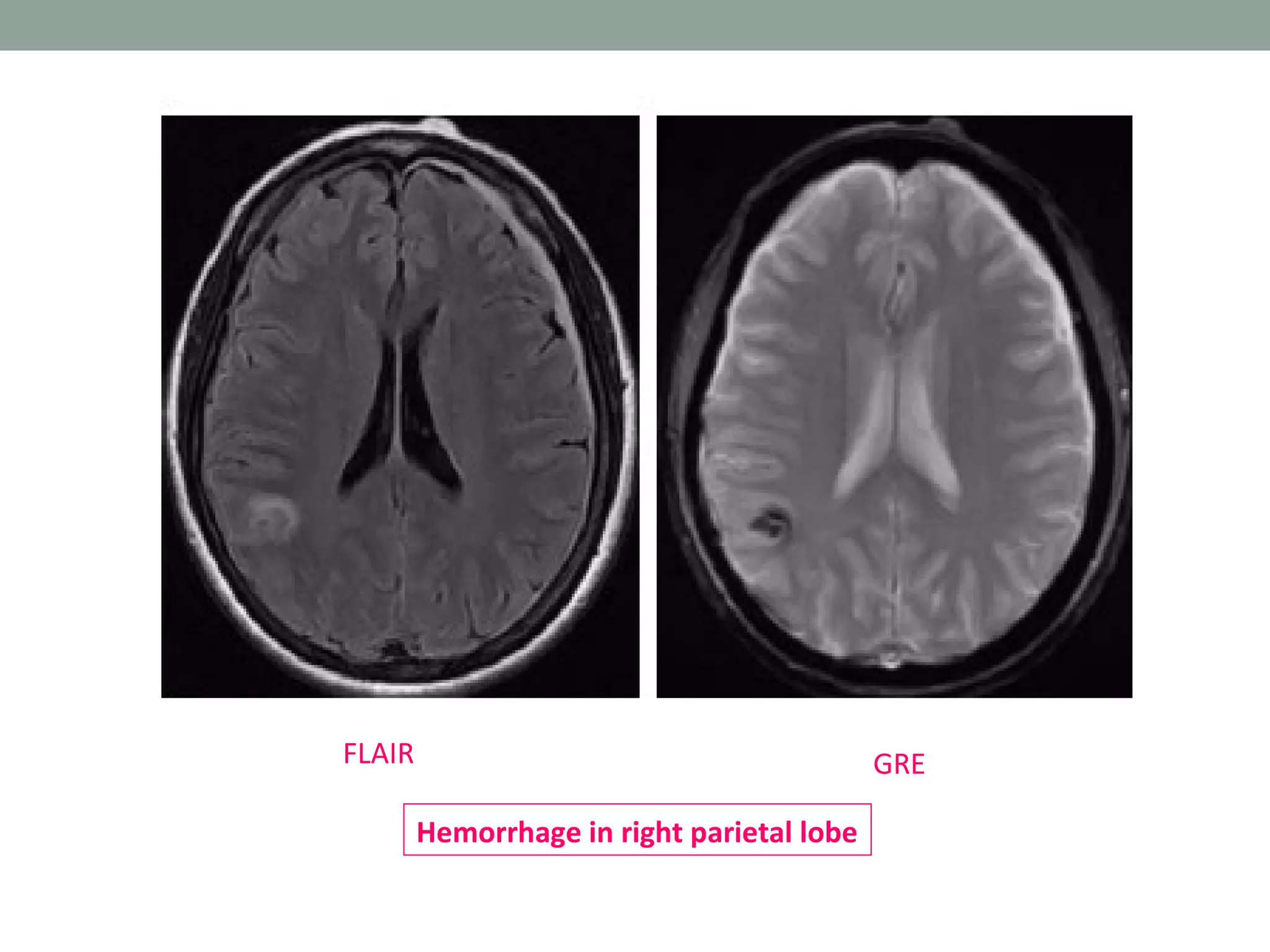 MRI brain; Basics and Radiological Anatomy | PPT