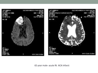65 year male- acute Rt ACA Infarct
 