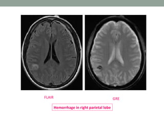GREFLAIR
Hemorrhage in right parietal lobe
 