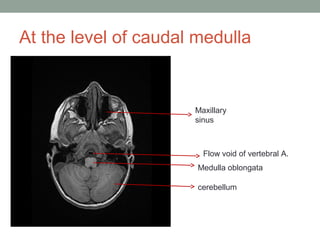 At the level of caudal medulla
Maxillary
sinus
Flow void of vertebral A.
Medulla oblongata
cerebellum
 