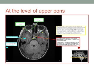 At the level of upper pons
 