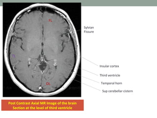 Post Contrast Axial MR Image of the brain
Section at the level of third ventricle
TL
FL
OL
Sylvian
Fissure
Temporal horn
Sup cerebellar cistern
Insular cortex
Third ventricle
 